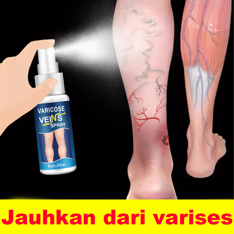 Krim varises, semprotan varises, vaskulitis vena, pembuluh darah bengkak, pereda nyeri, pengobatan e