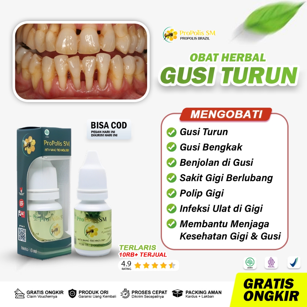 Obat Radang Gusi, Obat Gusi Turun, Obat Gusi Bengkak, Obat Gusi Mengelupas dari Gigi, Obat Gusi Berd