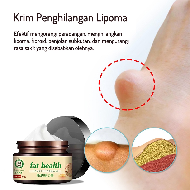 Lipoma Cream Obat Benjolan Lipoma SALEP KHUSUS BENJOLAN 30g OBAT BENJOLAN SALEP PENGHILANG BENJOLAN 