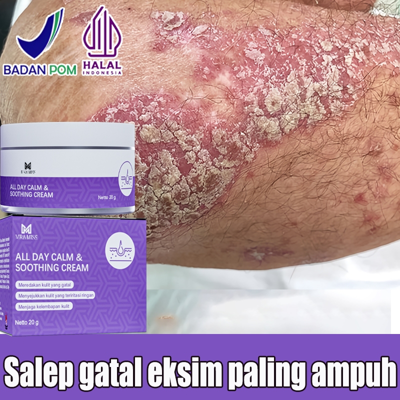 Obat kurap Obat gatal selangkangan 0bat gatal gatal di kemaluan Salep gatal eksim paling ampuh 20g S