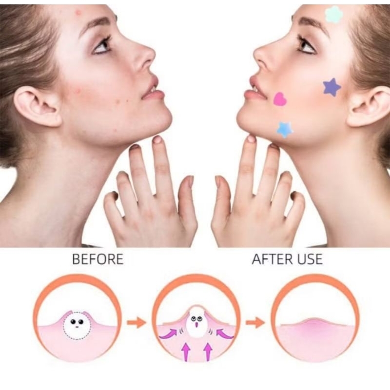 [OSM] Stiker Hydrocolloid Acne Pimple Patch Stiker Jerawat Bintang Love Colorful Murah Makassar Min 