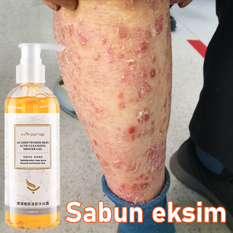 Sabun gatal kulit ampuh Sabun mandi gatal kulit ampuh sabun jerawat punggung acne body wash