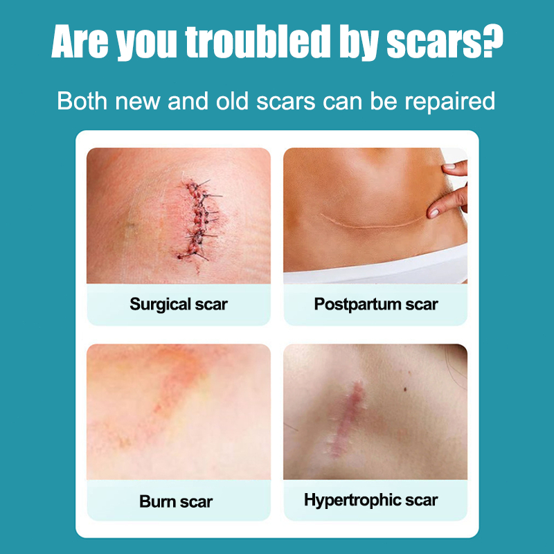 RB6 MANGOMAN Bekas Luka Jahitan, Gigitan Serangga, Bekas Luka Kaki, Luka Bakar, Bekas Luka Stretch