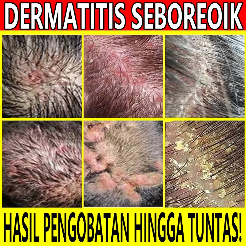 Obat Folikulitis, Folikulitis Kepala, Folikel Rambut,Obat Jamur Kepala, Obat Tinea Kapitis