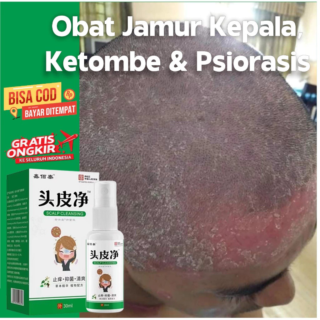 Obat Gatal Kulit Kepala 30ml Original Obat Anti Ketombe Basah Kering Kerak Psoriasis Gatal Jamur Kul