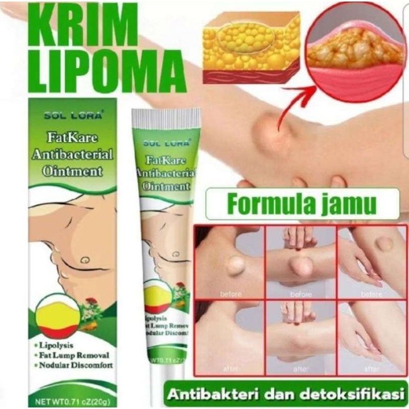 Obat Benjolan Lipoma Salep
Benjolan Tiroid Cream Penghilang Lipoma Herbal 20g Krim Lipoma cream Obat