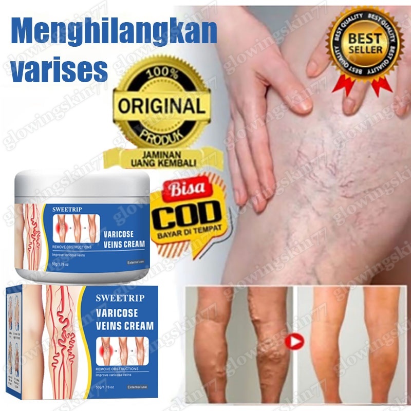 Sweetrip Varicose Veins Cream 50g Obat Varises Salep Penghilang  Obat Varises Di Kaki Dan Betis Pali