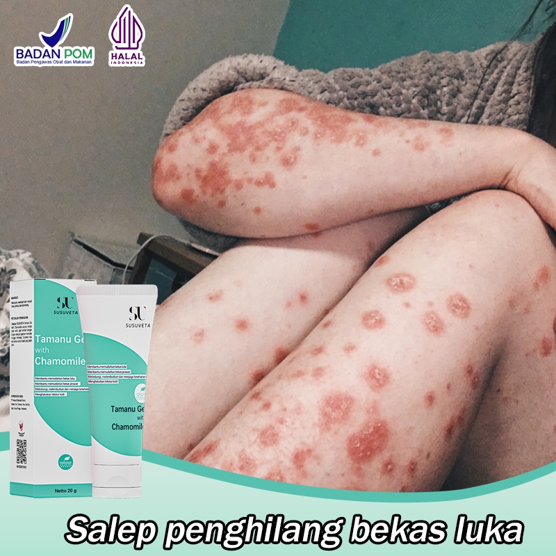 Salep bekas luka Cream penghilang bekas luka koreng Salep penghilang bekas luka 20g Obat bekas luka 