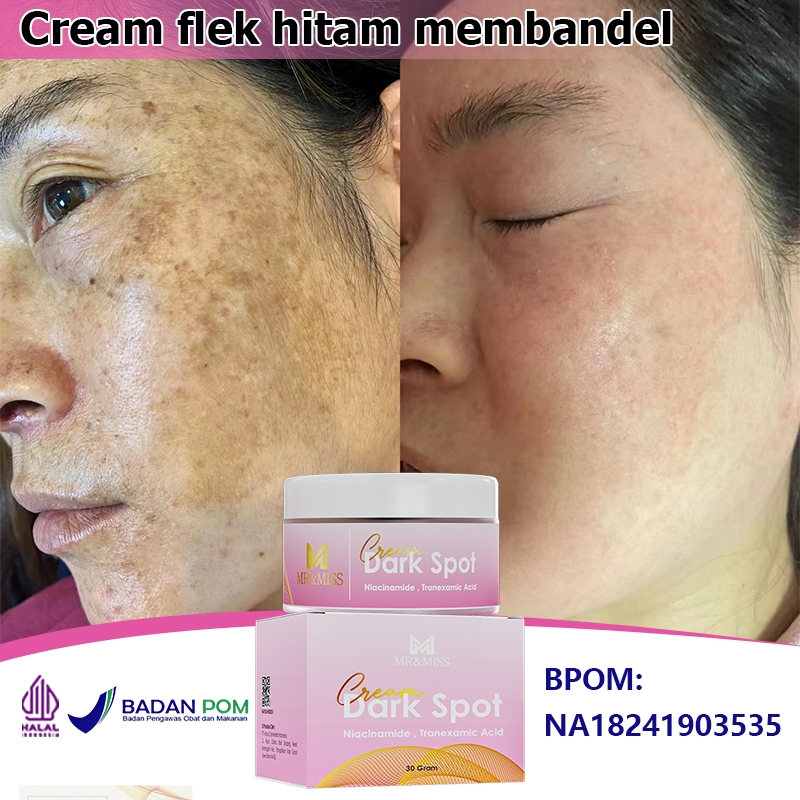 Krim penghilang flek hitam bpom Salep flek Menghilangkan flek hitam Cream flek hitam membandel bpom 