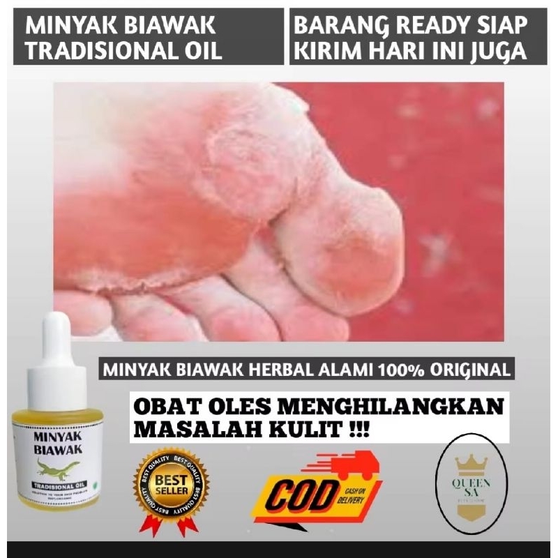 Obat Salep Minyak Biawak Asli Menyembuhkan Luka Bakar Koreng Cacar Panu Kudis Kurap Kutu Air Eksim