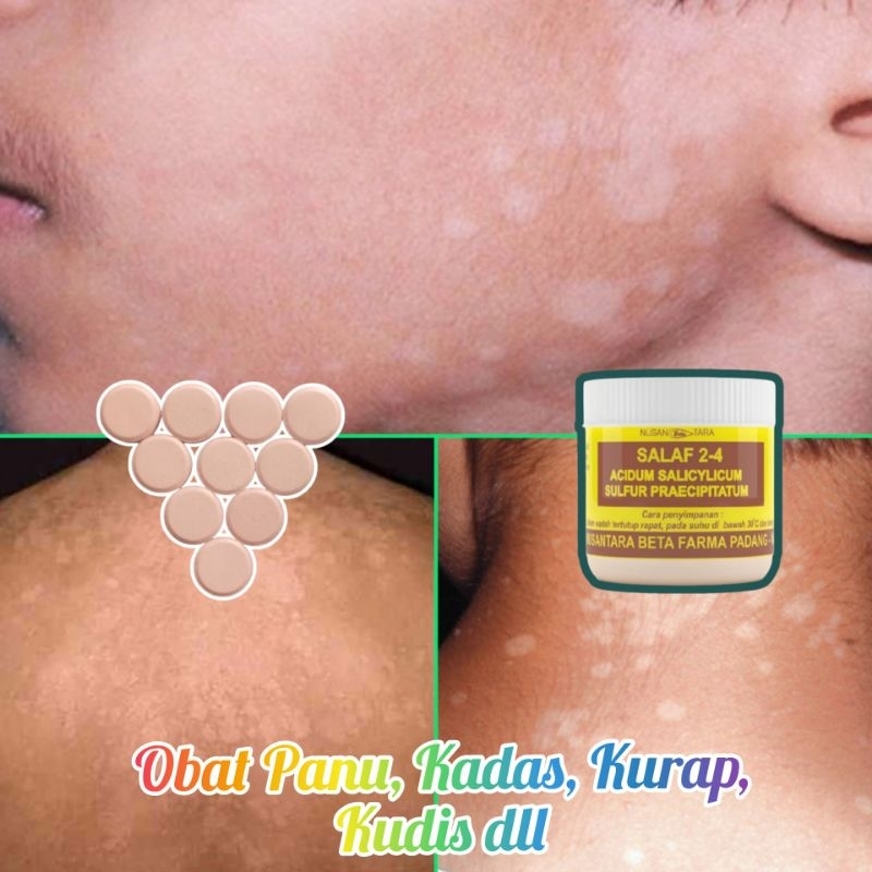 Obat Panu Kadas Kurap Jamur Kulit Ampuh - Mujarab