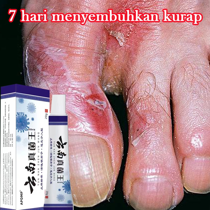 obat kaki rayapan jamur kuku dan bau kaki 20g Obat Kaki Rayapan Dan Bau penghilang bau kaki obat jam