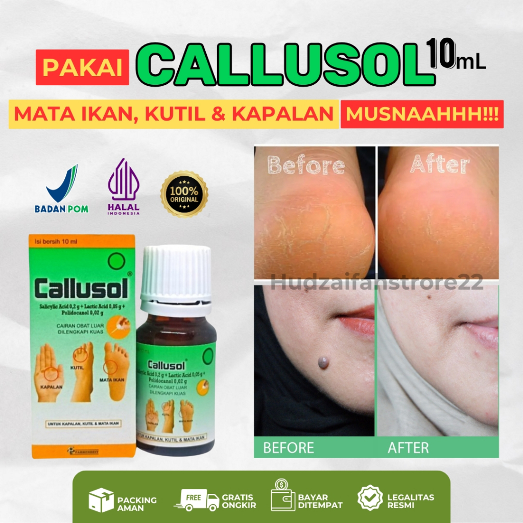 Obat Callusol 10ml Cair Yang Ampuh Untuk Kapalan Tangan Mata Ikan Di Kaki Badan Wajah Pembersih Peng