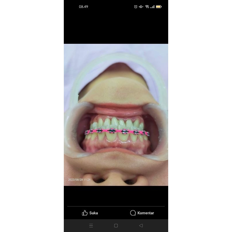 behel lepas pasang