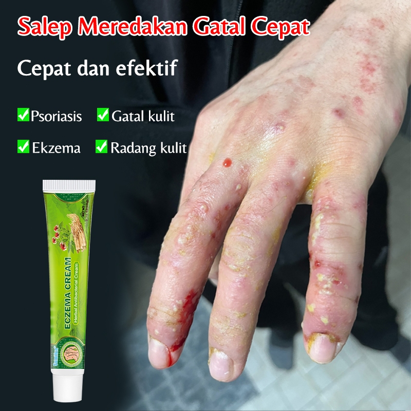 Salep gatal/Salep Gatal Kulit Ampuh/salep gatal selangkangan20g krim eksim kulit kurap,psoriasis,Der