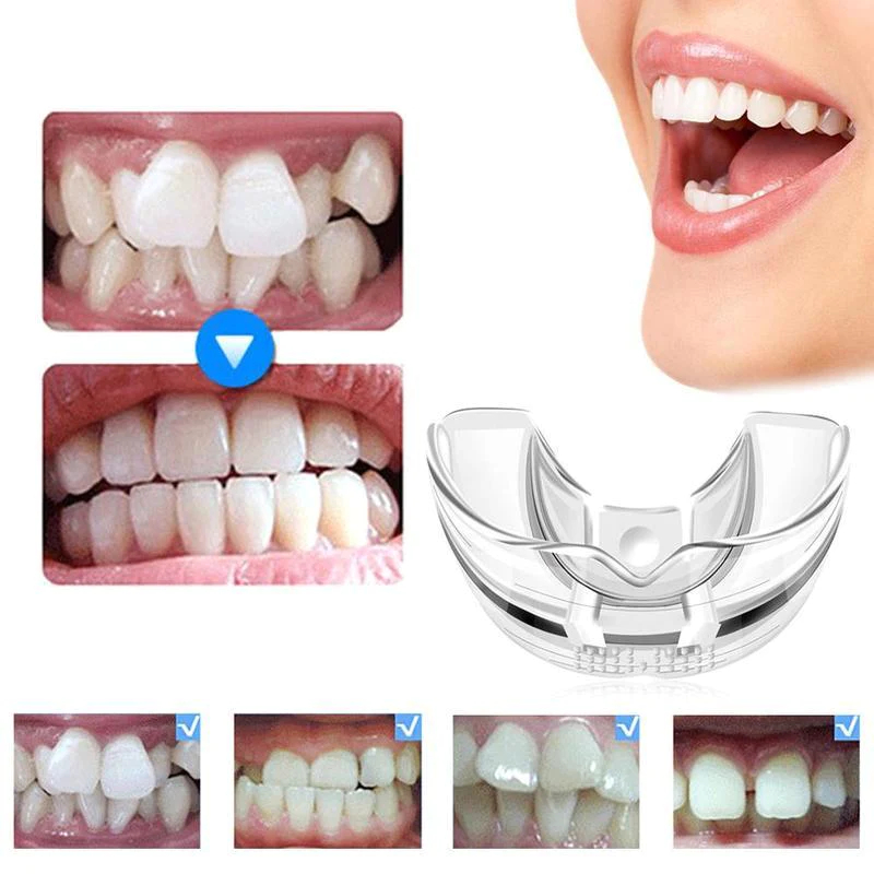 Perapi Gigi Anak Kids Teeth Trainer Allignment Orthodentic Retainer Anak Behel Kawat Gigi Transparan