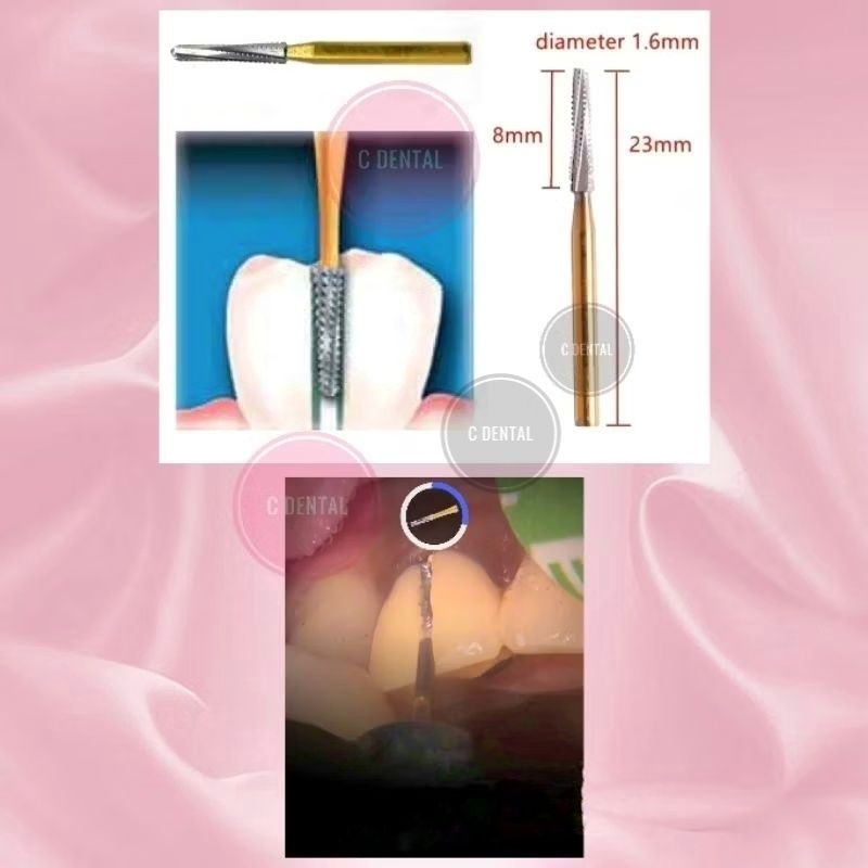 Dental Carbide Crown Cutting Bur Long Shank Bongkar Metal Crown Gigi Anterior Posterior (High Speed)