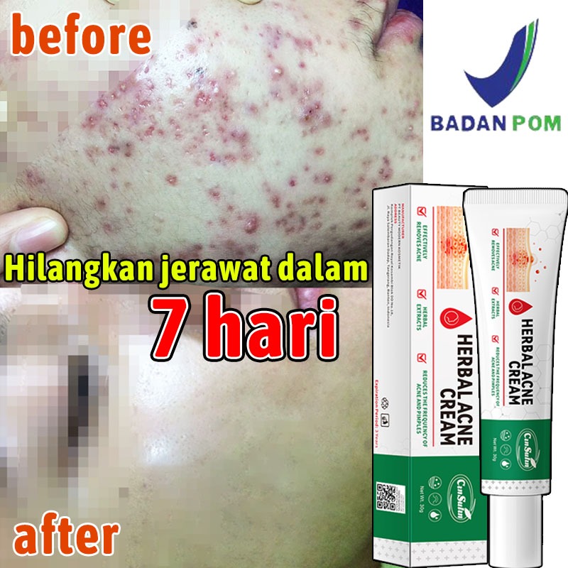 BPOM HERBAL ACNE CREAM-penghilang jerawat dan bekas/cream pemutih waj glowing/krim penghilang flek h