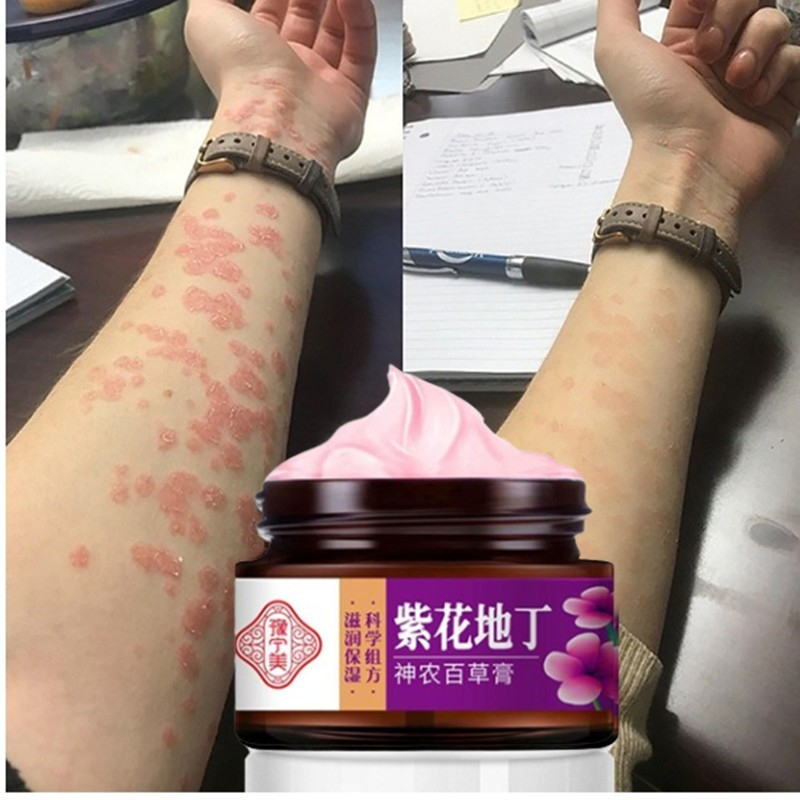 Asli 100% 30Gr Salep Cina Salep Obat Gatal Salep Psoriasis Eksim Jamur Kurap Alergi Kulit Cream Ecze