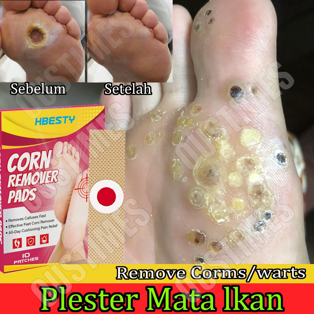 Obat Mata Ikan Obat Kutil Penghilang Mata Ikan Plester Kutil Mata Ikan corn caps plaster Ampuh