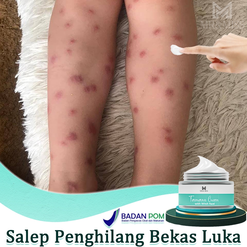 Salep penghilang bekas luka menghilangkan bekas luka cream 20g penghilang bekas luka hitam koreng sa