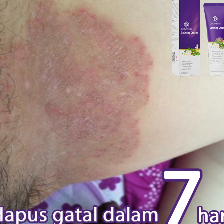 Terjangkau Salep gatal selangkangan bat gatal gatal di kemaluan bat gatal gatal seluruh badan obat k