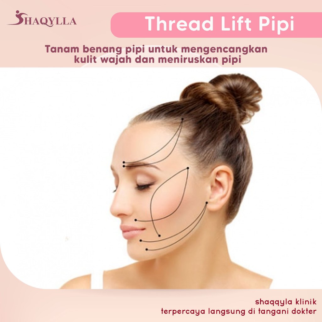 Shaqylla Treatment Perawatan Thread Lift Tanam Benag Pipi Wajah Muka