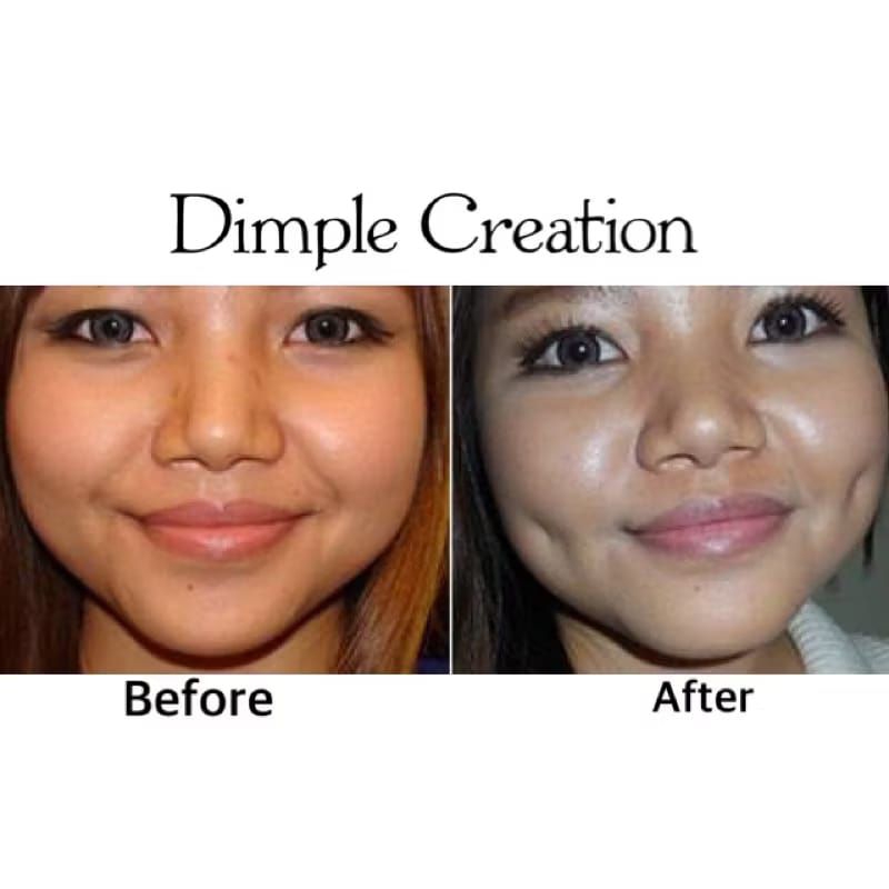 Dimple Pin Lesung Pipi Jarum Lesung Pipi Needle Sulam Lesung Pipi