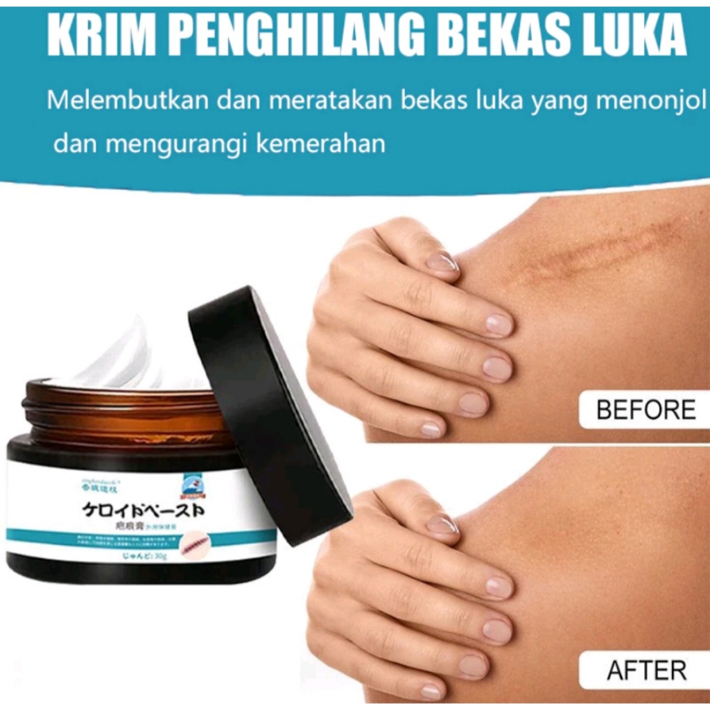Penghilang bekas luka cream penghilang bekas luka cacar kaki wajah koreng bekas sayatan keloid