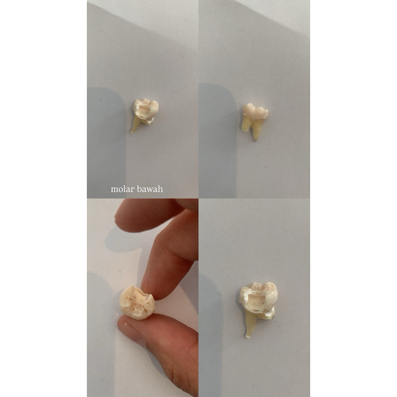 Gigi Molar Rahang Bawah