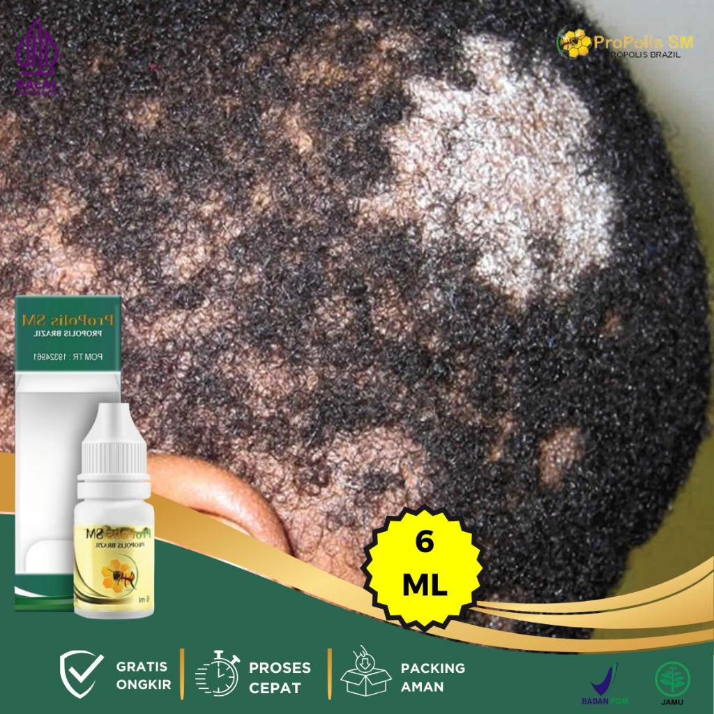 Obat Oles Jamur Kulit Kepala, Obat Koreng Di Kepala, Obat Borok di Kepala, Obat Tinea Capitis, Obat 