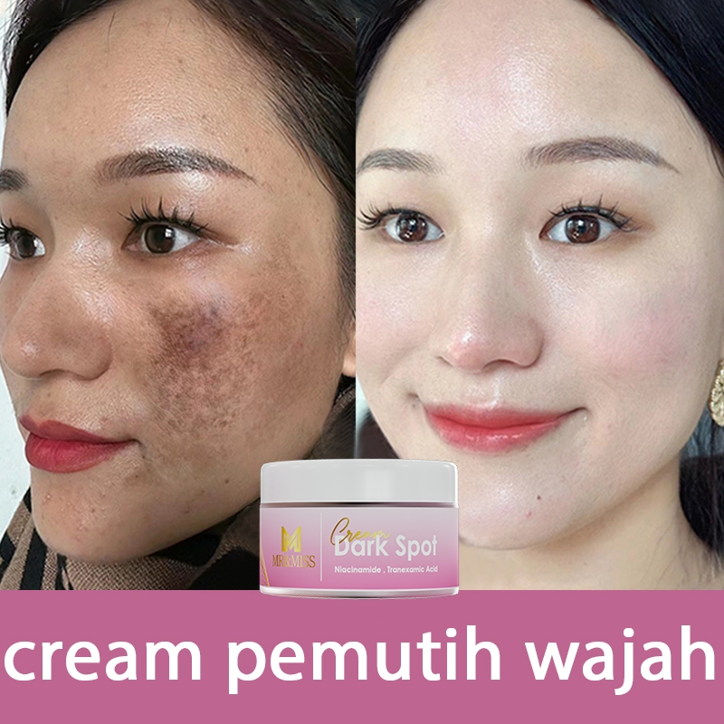 【BPOM】Cream flek hitam membandel bpom Salep flek hitam membandel  30g menghilangkan flek hitam di wa