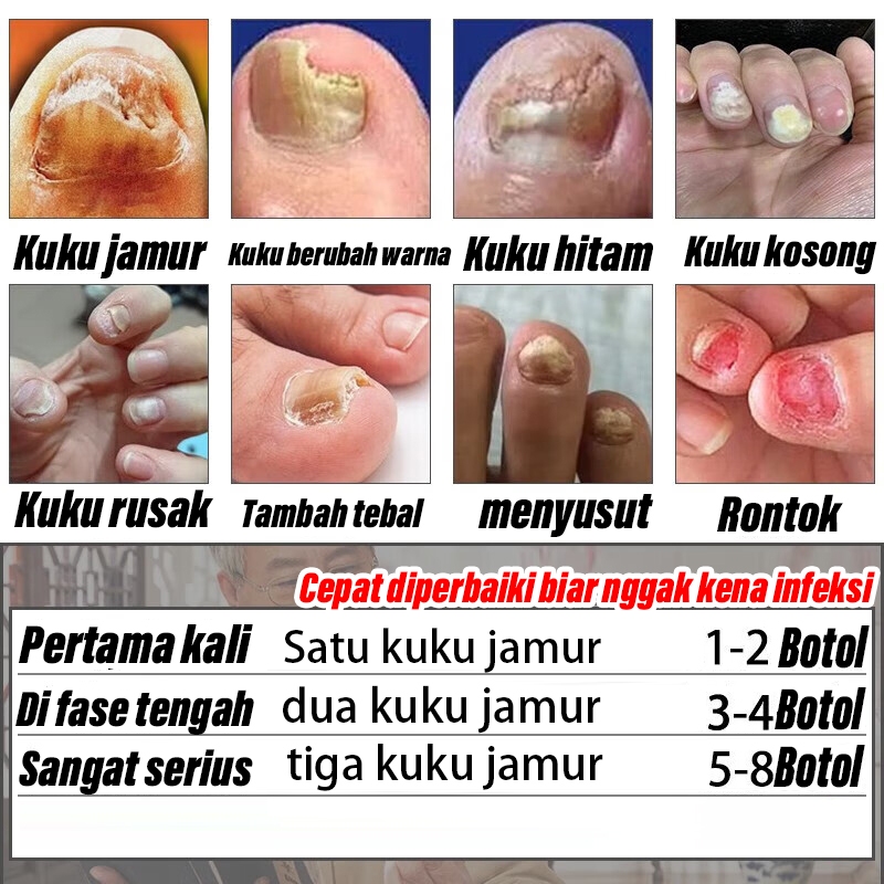 Obat jamur kuku Obat kuku Perawatan kuku Obat kuku rusak 30ml obat cantengan obat kuku jamur dan rus
