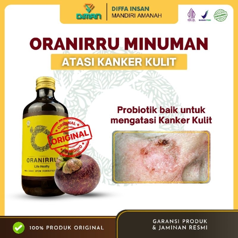 

ORANIRRU–Jamu Herbal Alami untuk Membantu Atasi Masalah Kanker Kulit, 100% Original & Terbukti Ampuh
