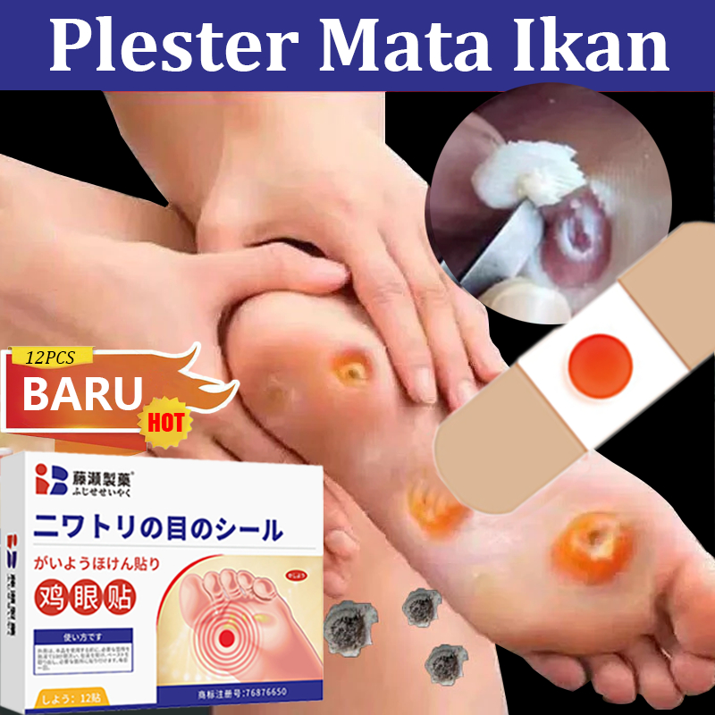 Plester Mata Ikan Paling Ampuh Jepang 0bat Mata Ikan Di Kaki Penghilang Mata Ikan Di Tangan Foot Cor