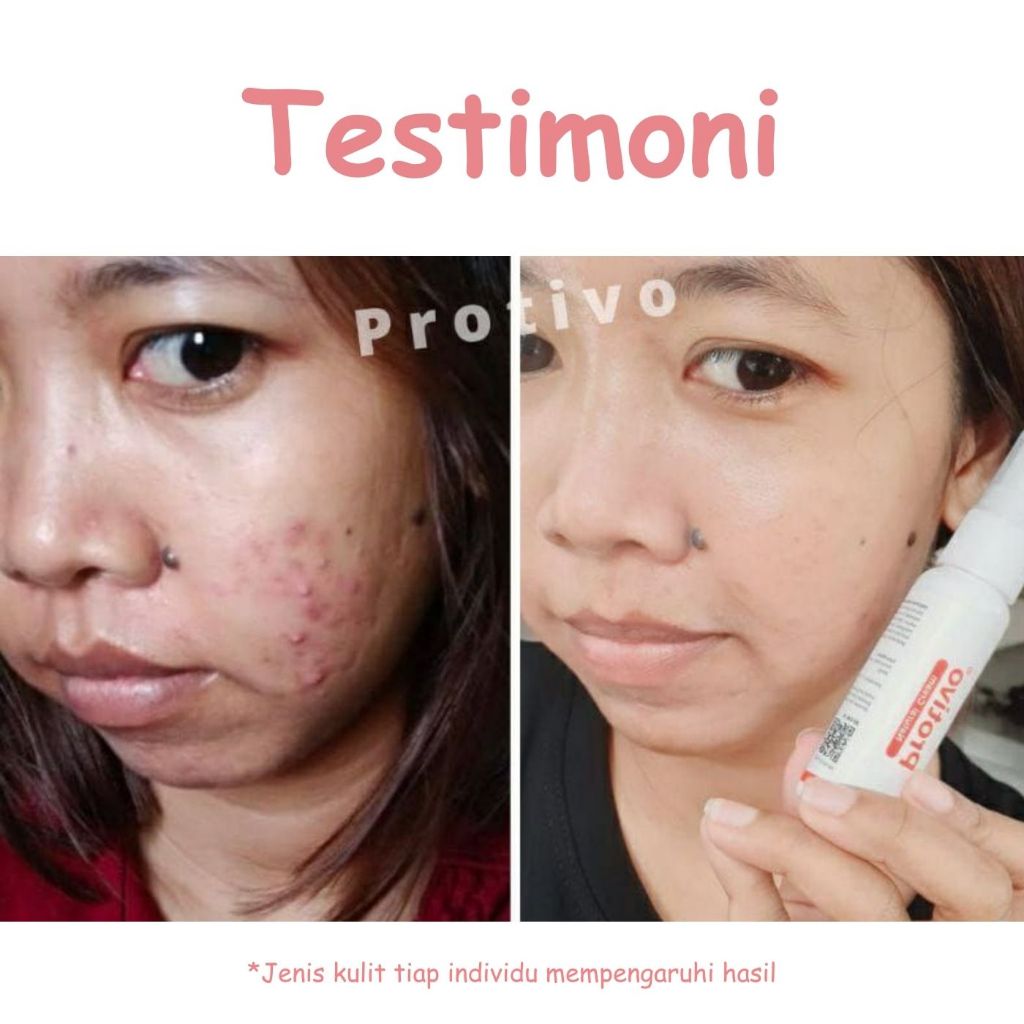 Auto Jewelery P Gatal Protivo Cream Original Asli Obat Gatel Kemaluan Dan Selangkangan Cream Jerawat