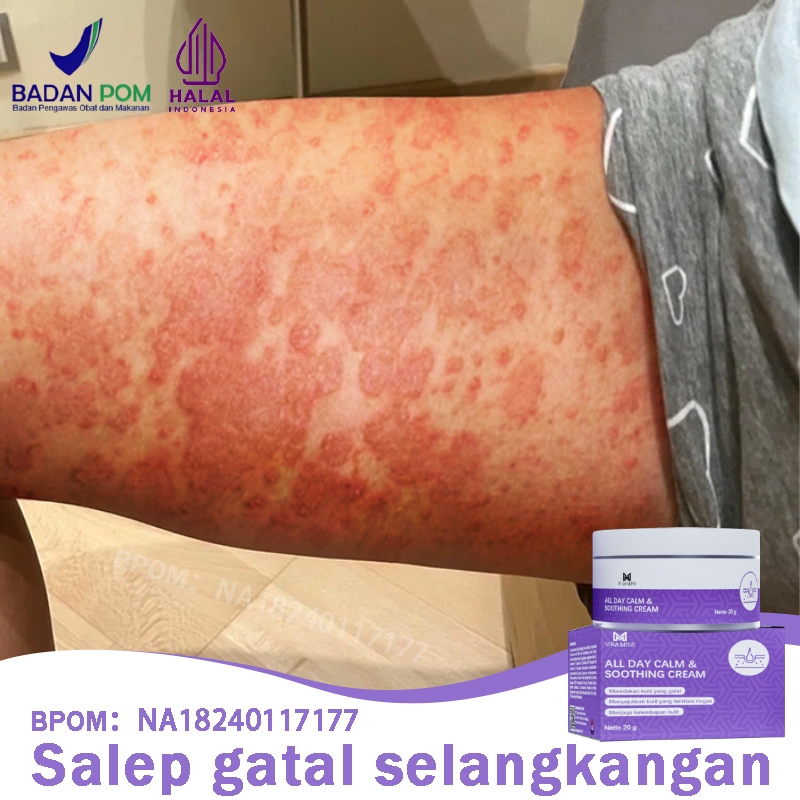 Salep gatal Salep gatal selangkangan Obat gatal Salep eksim kering paling ampuh 20g Obat Gatal Kulit