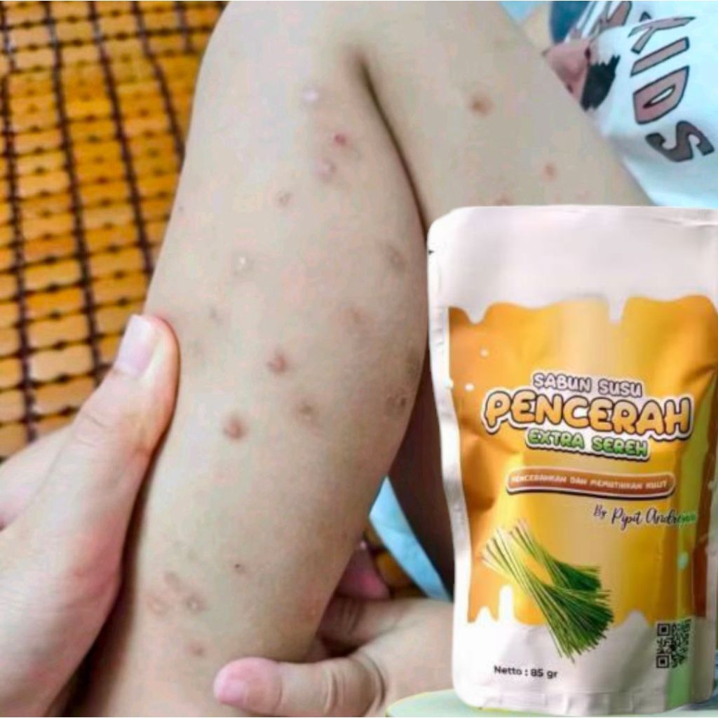 sabun penghilang bekas luka lama - sabun pemutih extra sereh menghilangkan bekas luka bekas koreng d