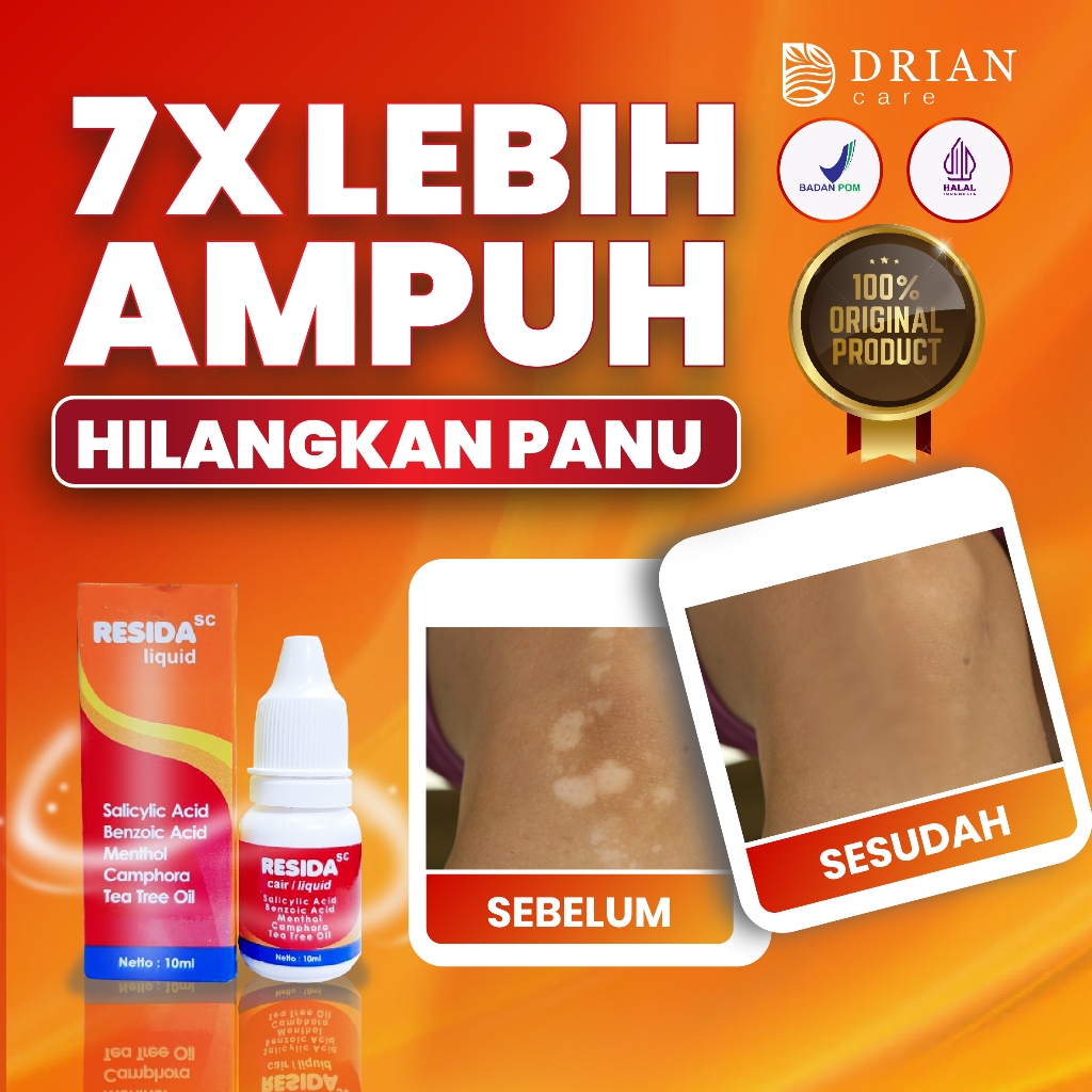 Resida Obat Panu Gatal Kulit Paling Ampuh 100% Dan Paling Cepat Obat Panu Gatal Kulit Kadas Kurap Ku