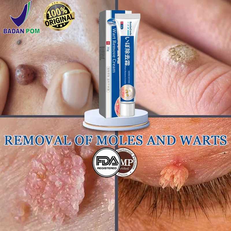 （BPOM）penghilang kutil ampuh salep kutil remover salep penghilang kutil di wajah wart removal cream 