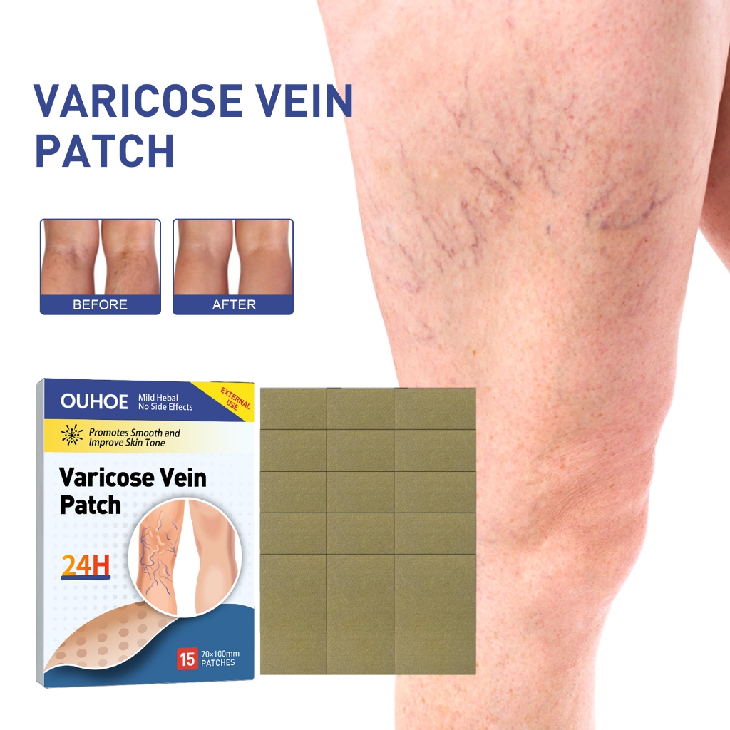 OUHOE 15pcs Koyo Varises Penghilang Varises Di Kaki Varicose Patch Obat Varises Herbal Koyo Varicose