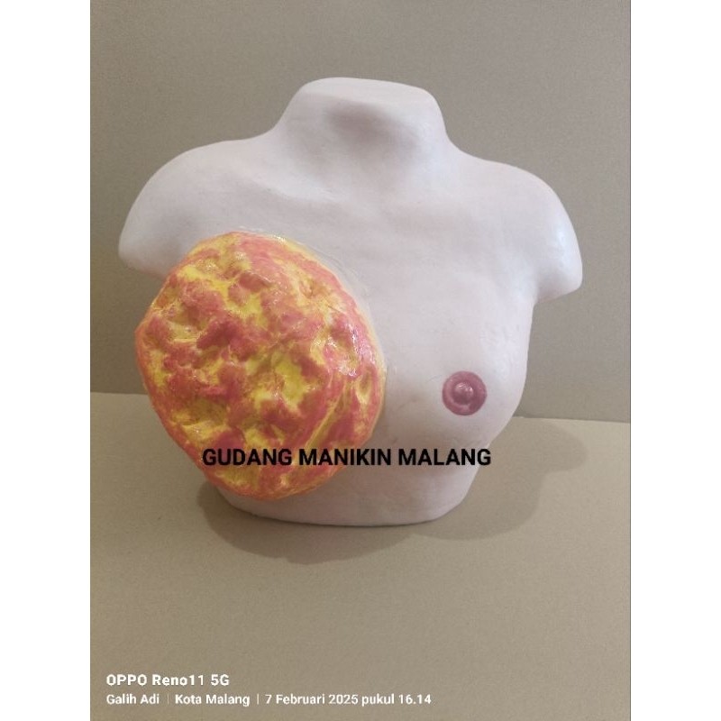 MANIKIN -TUMOR PAYUDARA / PHANTOM MANIKIN TUMOR PAYUDARA / ALAT PERAGA KANKER PAYUDARA