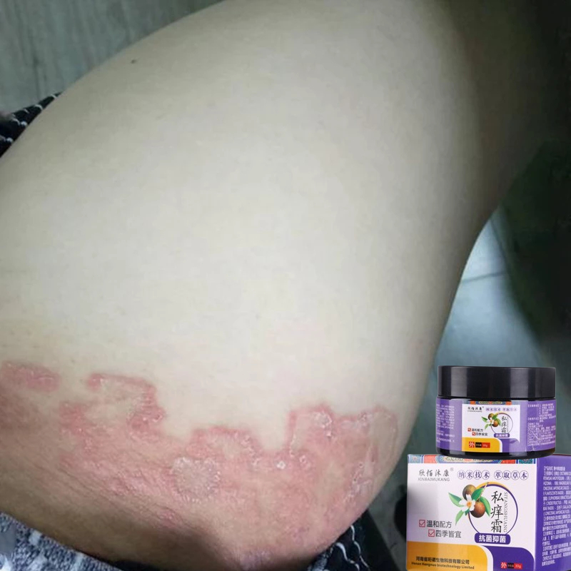 Salep gatal paling ampuh Obat gatal selangkangan salep gatal kulit yang ampuh 30g Salep gatal selang