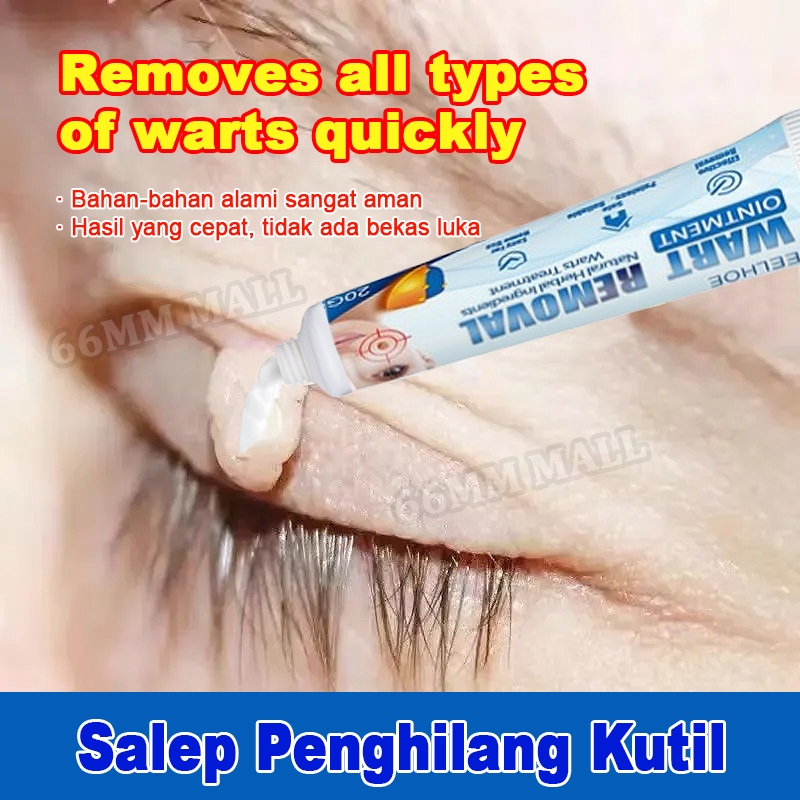 Penghilang Tahi Lalat Salep Kutil Paling Ampuh 20g Penghilang Kutil dan Tahi Lalat Callusol Kutil Wa