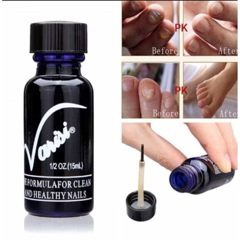Varisi Obat Jamur Kuku - Penghilang Jamur Kuku