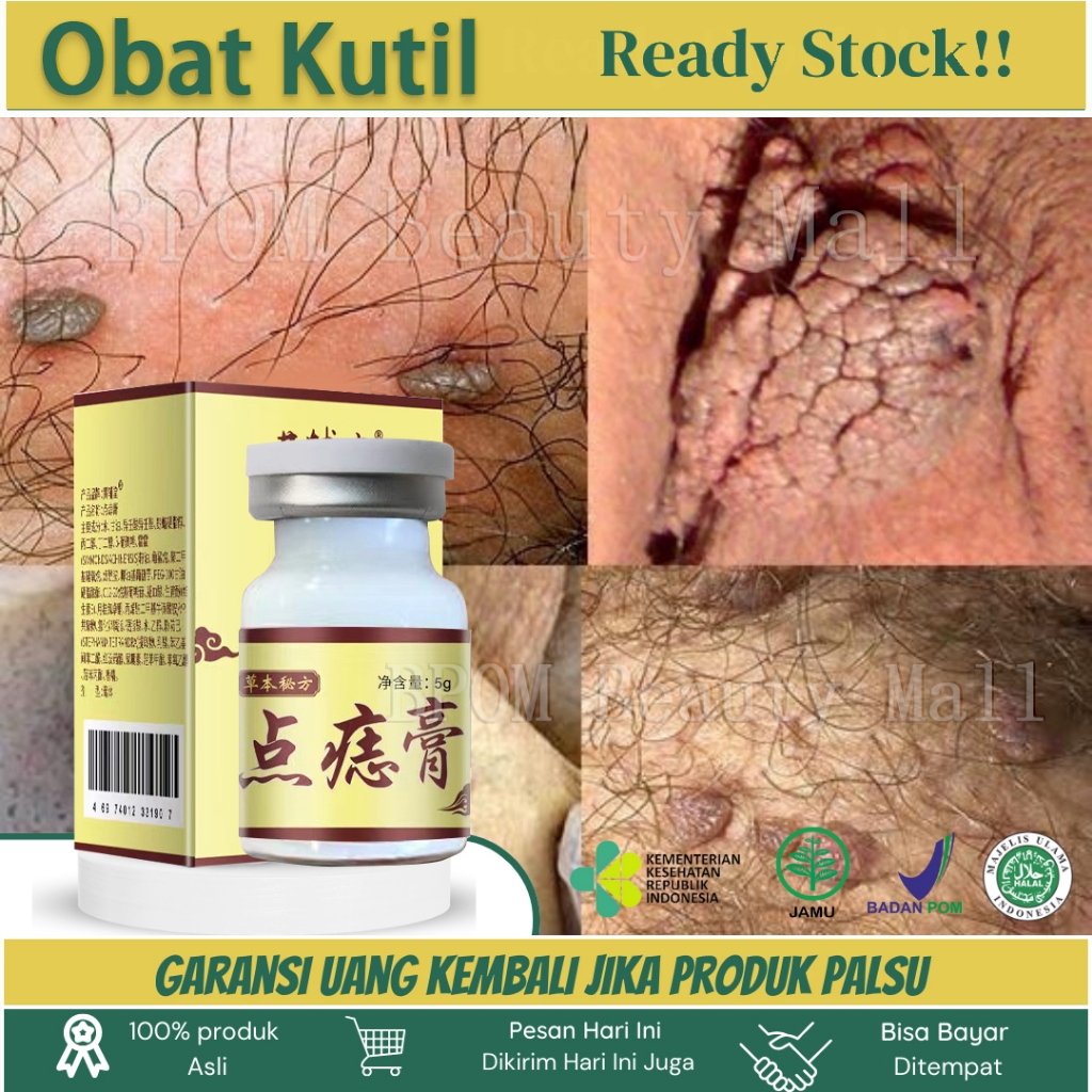Efek bagus Obat Kutil paling ampuh Oles Penghilang Kutil 20g manjur tanpa operasi mahal penghapus me