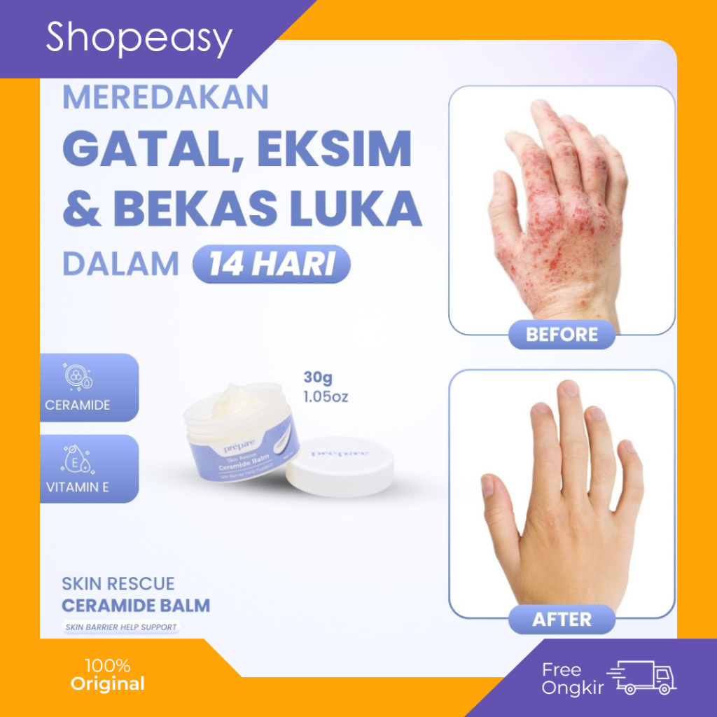 Prepare Salep Eksim Eczema Pelembab Kulit Kering Tangan Kaki Gatal Gatal Bekas Jerawat Punggung