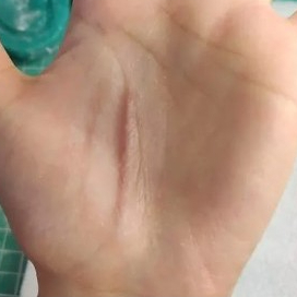 LUKA KELOID PALSU | SILIKON PROSTETIK KELOID | KELOID KECIL | BEKAS LUKA KECIL | MEDICAL SFX | SFX T