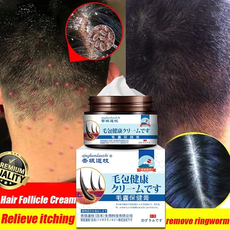 【100% ampuh】Obat Kurap Jamur di kulit Kepala, Kulit Kepala Berjamur, Kulit Kepala Gatal Berjamur, Ob