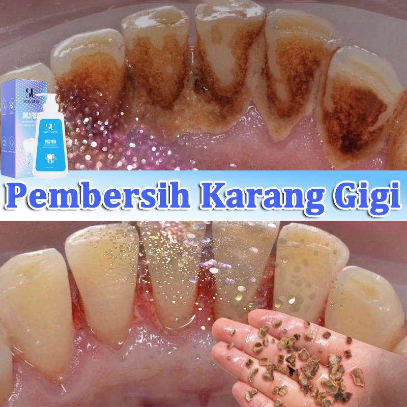 perontok karang gigi odol pemutih gigi odol pemutih gigi dan karang gigi 100ml pembersih karang gigi